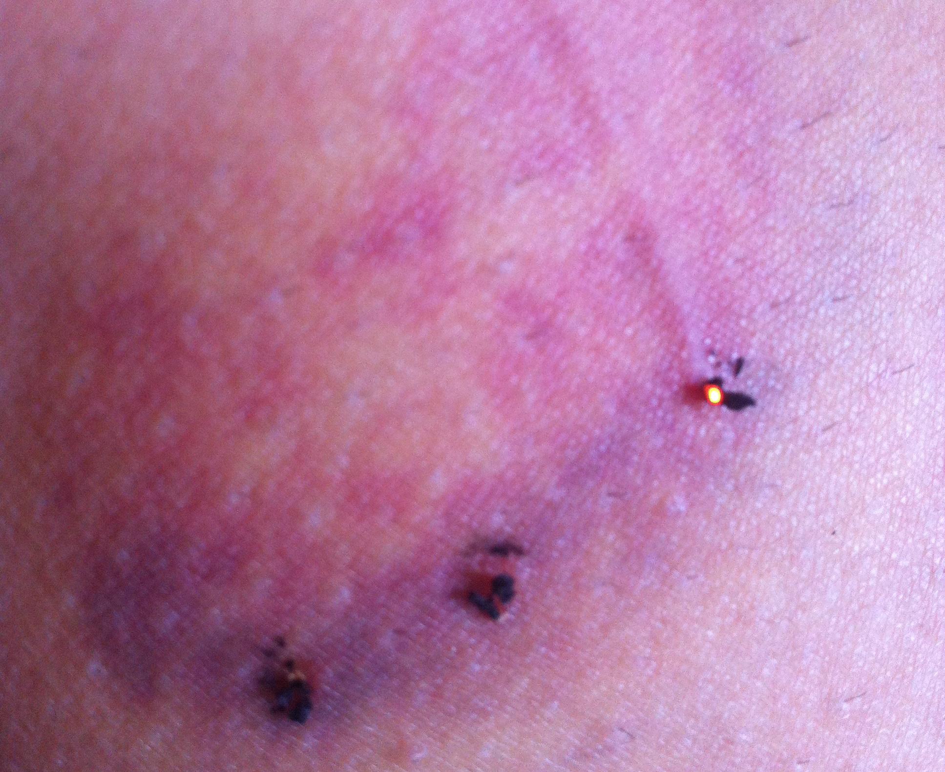 Japanese moxa works very well to heal bruises